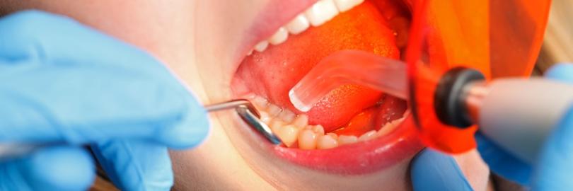 Zahnbehandlung - Härten einer Kompositfüllung